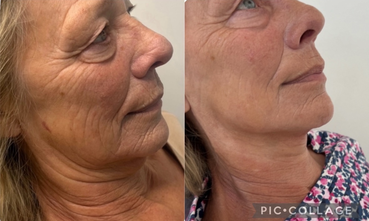 HIFU skin tightening treatment at Face & Brow Cosmetics